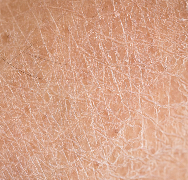 image peau sèche