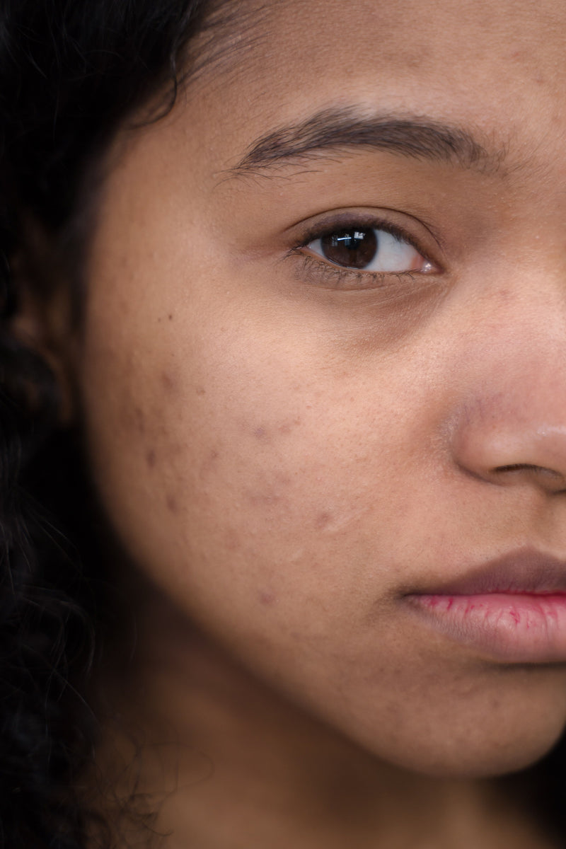 Peau à imperfections